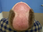 hair transplant after surgery