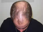 hair transplant before picture