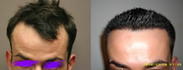 hair transplant photo