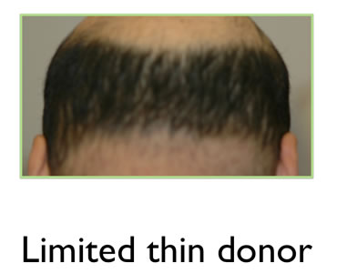 hair transplant donor