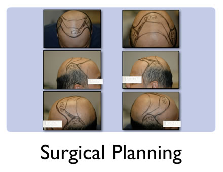 hair transplant pattern