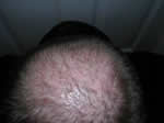 hair transplant pimples