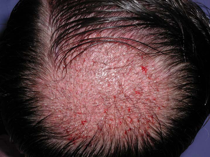 Crown Transplant