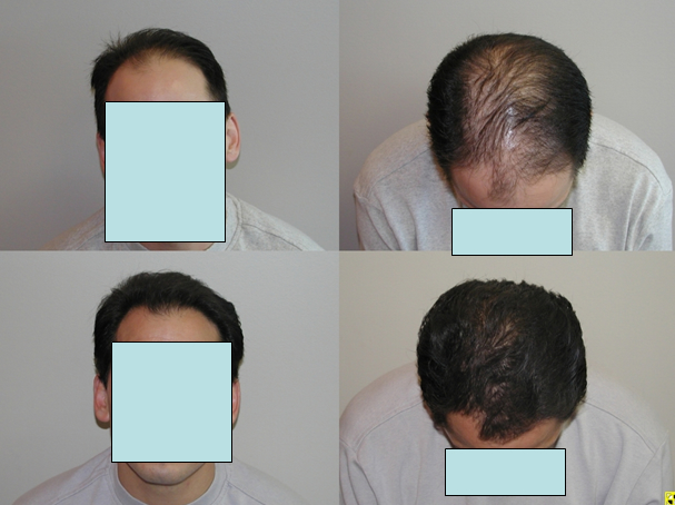 Before And After Rogaine. finasteride, Rogaine,