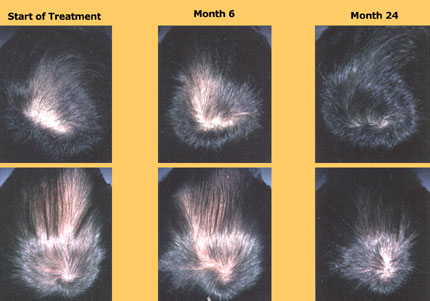 Propecia Vs Avodart Hair