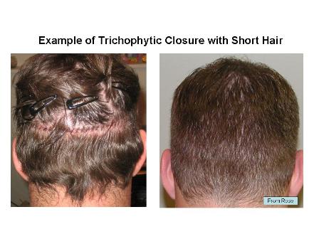 Trichophytic Closure with hair short