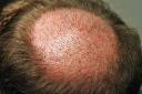 Very natural crown whorl graft placement