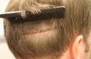 Use of Trichophytic closure results in minimal scarring of the donor area