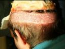 Donor area of FUE procedure