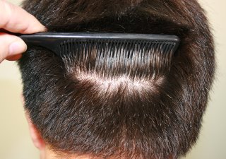 The “Invisible When Wet” Hair Transplant Donor Scar