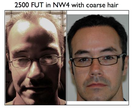 Hair transplant preop