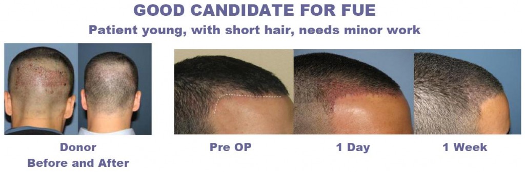 fue_good_candidate_hair_transplant1