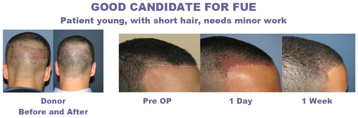 Diet After Fue Hair Transplant