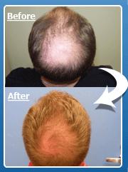 can metformin help regrow hair