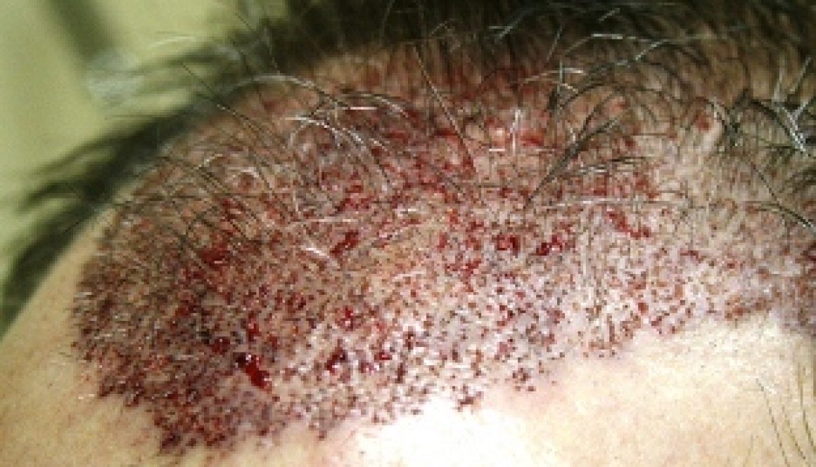 What Is a Realistic Expectation for Dense Packing a Hair Transplant?
