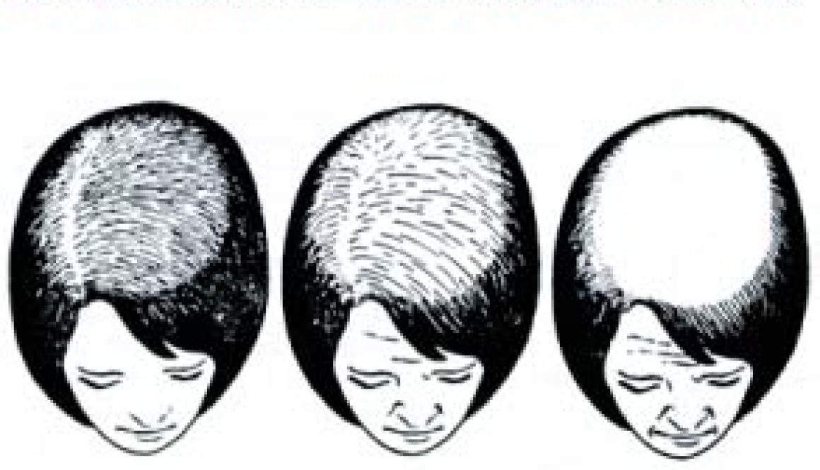 The Causes and Treatments for Female Hair Loss