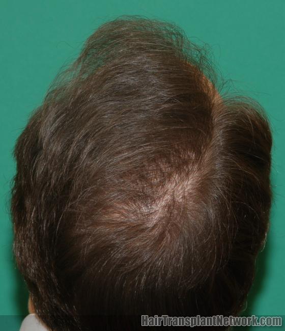 will finasteride 5mg regrow hair