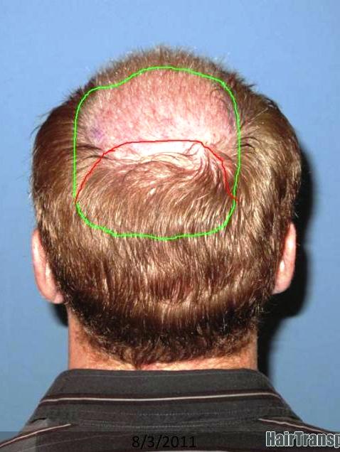 When Is It Appropriate To Address Hair Loss In The Crown With Hair