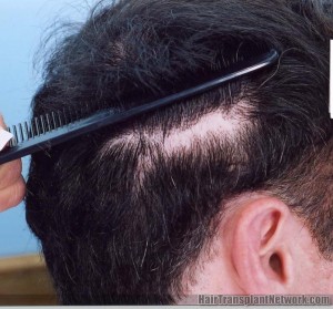 Hair Transplant Donor Scar