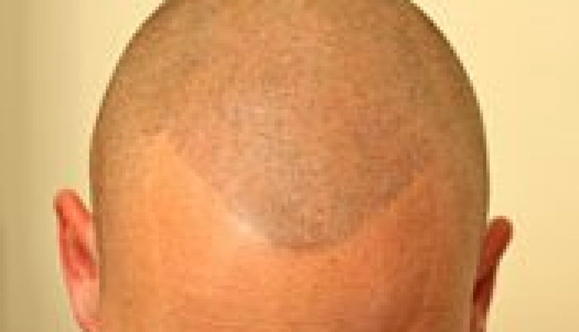 Concealing Hair Loss with Scalp Micropigmentation (SMP)
