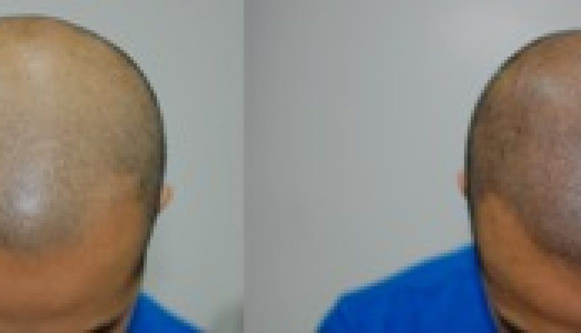 Combining a Hair Piece with Scalp Micropigmentation (SMP) to Hide Hair Loss?