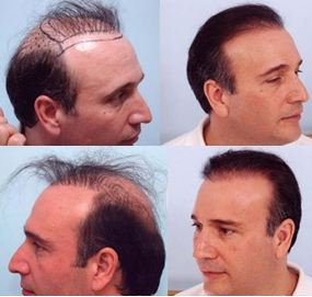 Image result for fut hair transplant