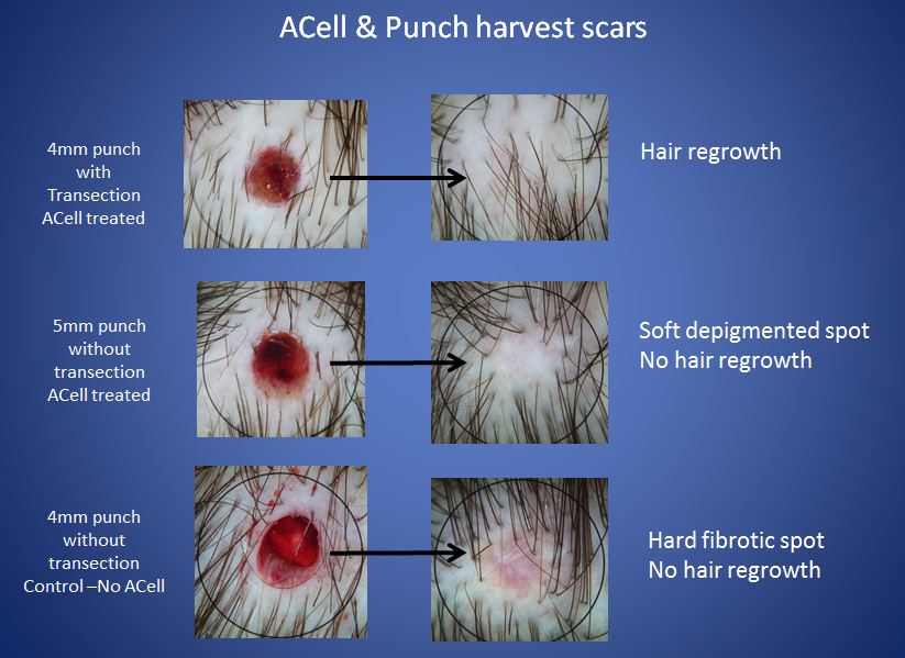 Hair Color Tutorial Images Acell Prp Hair Loss with Combing Hair also Hair Color Tutorial Images Acell Prp Hair Loss with Combing Hair also