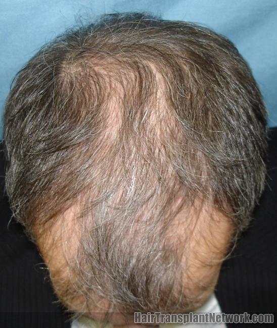 Does propecia regrow hair