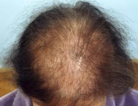 female hair loss