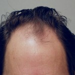 Vogel FUE 2,700 Before