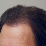 Vogel FUE 2,700 Grafts 1
