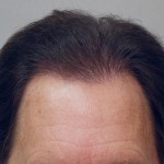 Vogel FUE 2,700 Grafts 2