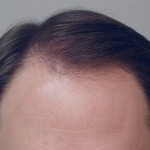 Vogel FUE 2k Front After