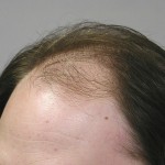 Vogel FUE 2k Side Before