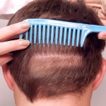 Vogel Stealth FUE Extraction 2 weeks