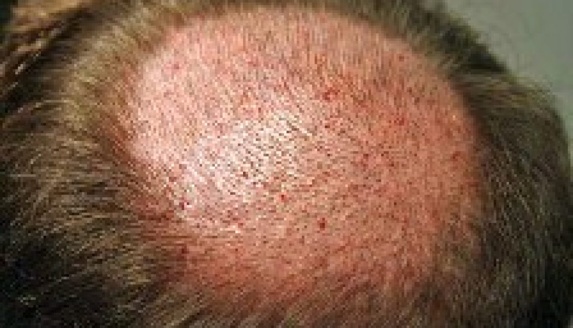 Why Do Doctors Advise Against Hair Transplant Surgery In The Crown