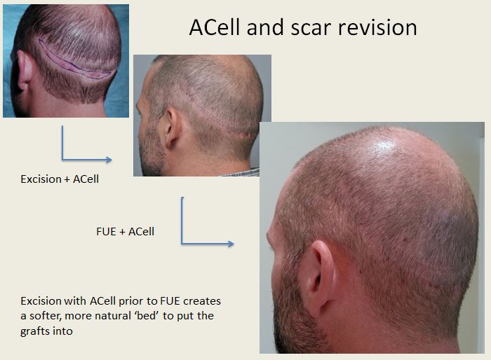 scar revision