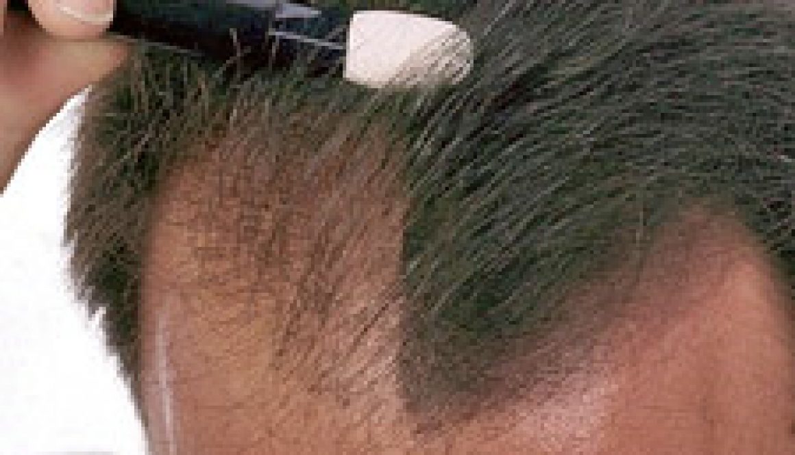 hair loss concealers