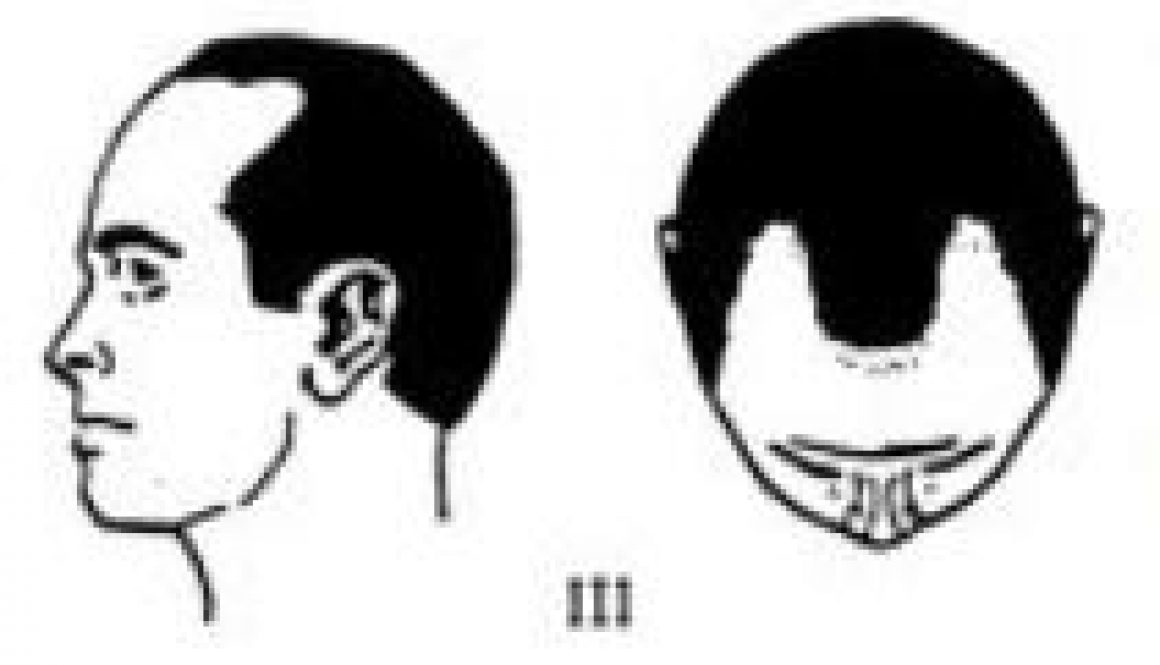 receding hairline