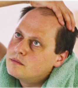 getty_rm_photo_of_male_hair_loss