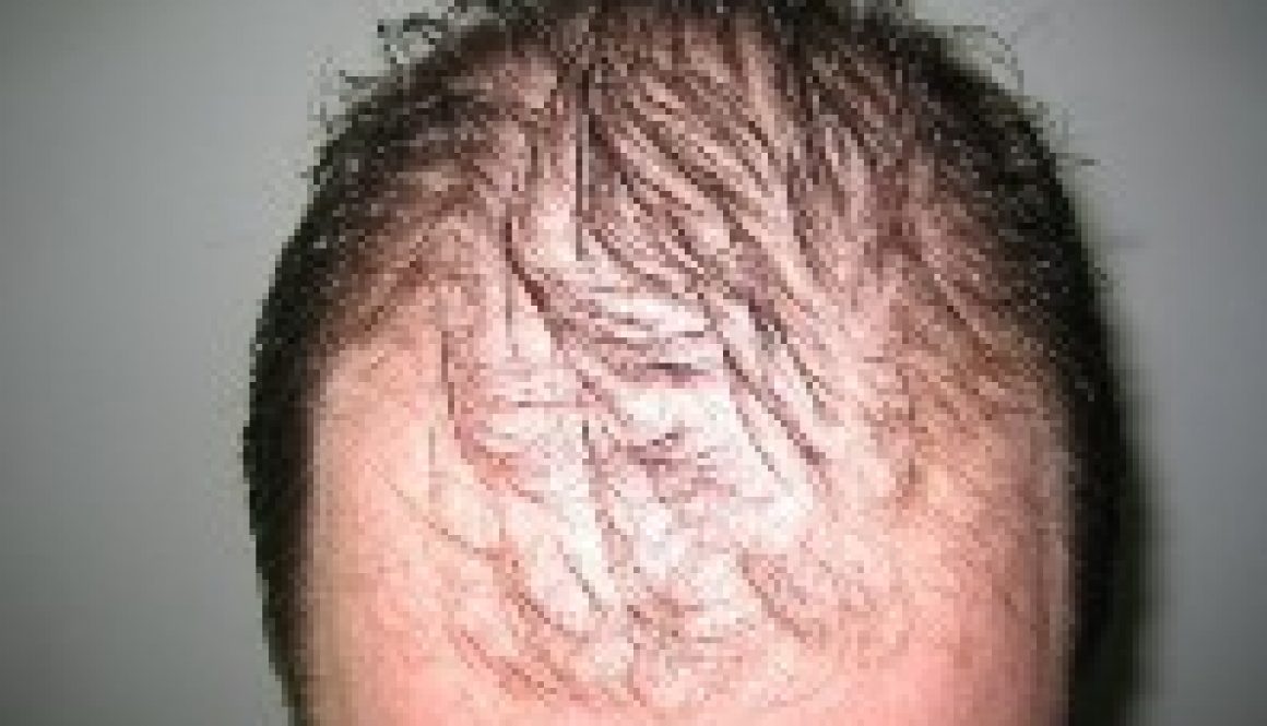 telogen effluvium