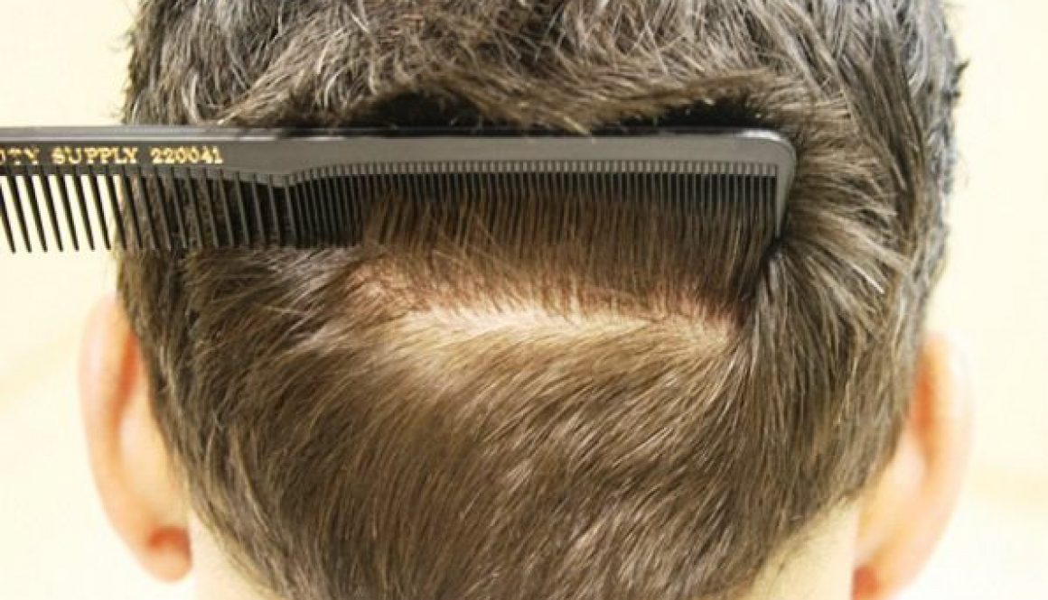 back-donor-after-hair-transplant-2552-grafts-Dr-Alexander