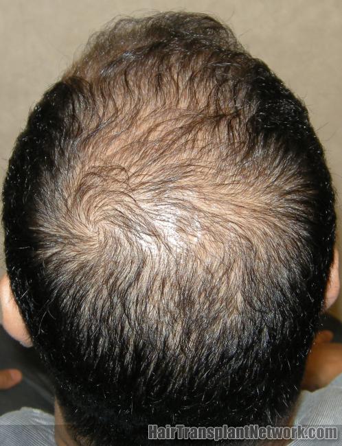 is kirkland minoxidil good for hair growth