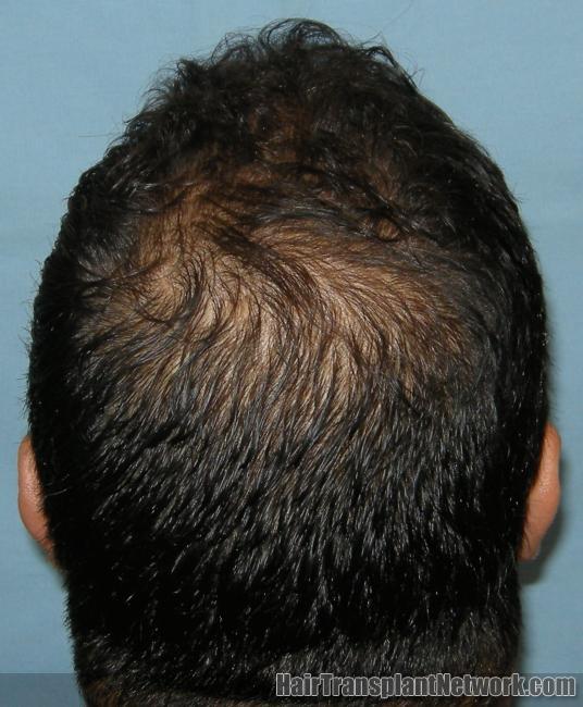 is rogaine good for hair loss