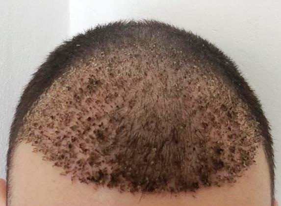 Hair Transplant Insurance