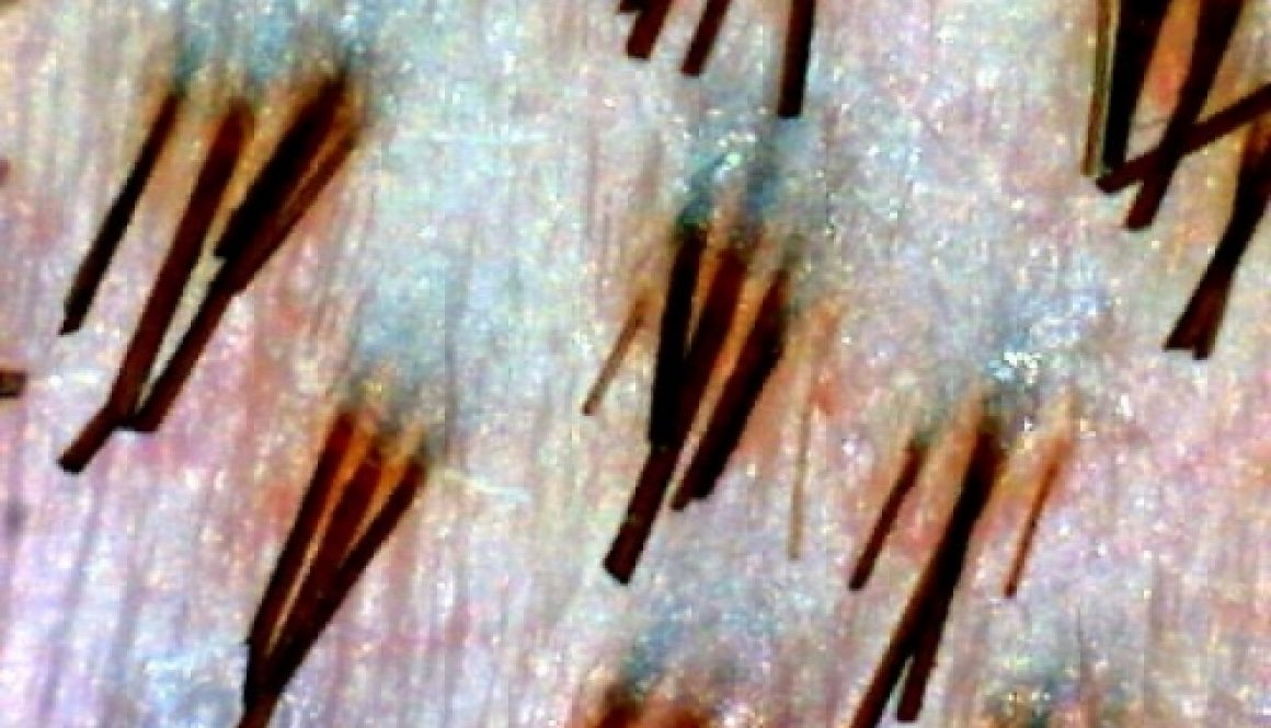 follicular units