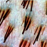 follicular units