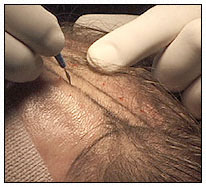 hair_transplant_step_9