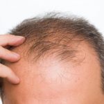 hairloss