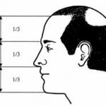 high-hairline
